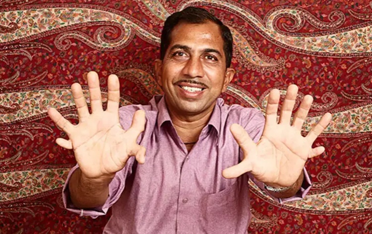 Devendra Suthar, the Living Person with the Most Fingers and Toes - Guinness Title Holders
