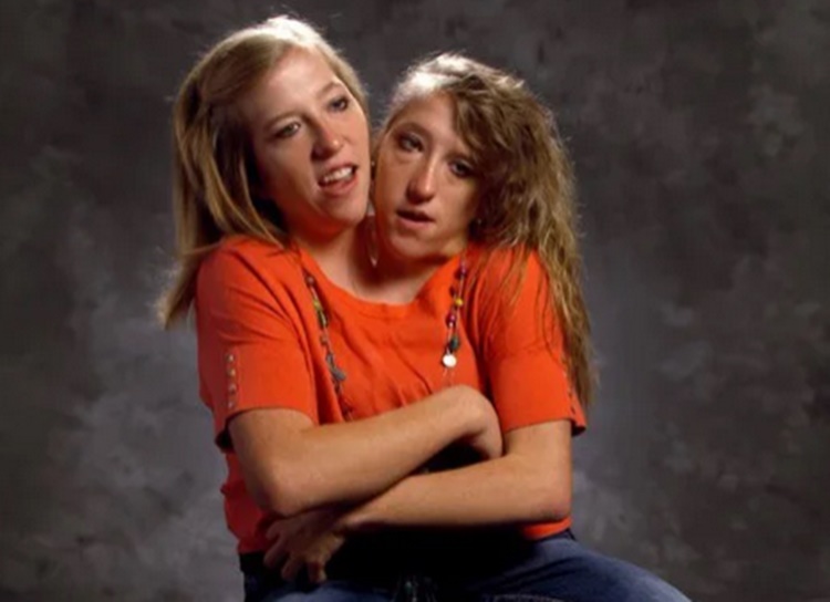 Abby and Brittany Hensel 5