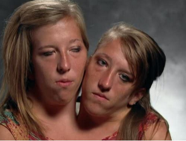 Abby and Brittany Hensel 5