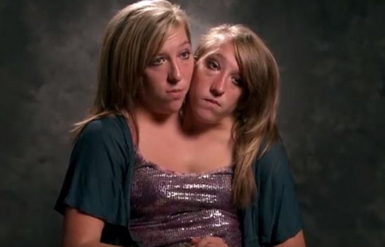 conjoined twins